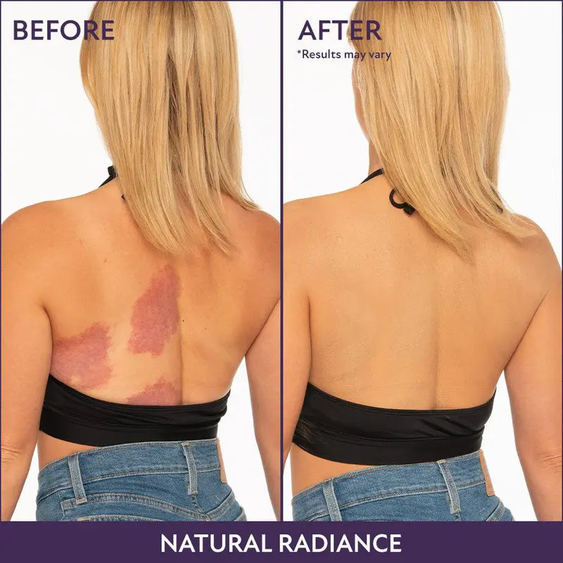 Covers Scars & Stretch Marks — Looks Like Real Skin